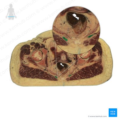 Coccygeus muscle (Musculus coccygeus); Image: National Library of Medicine
