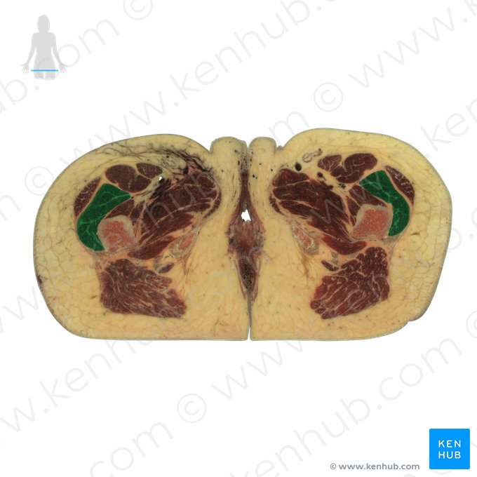 Músculo vasto lateral (Musculus vastus lateralis); Imagem: National Library of Medicine