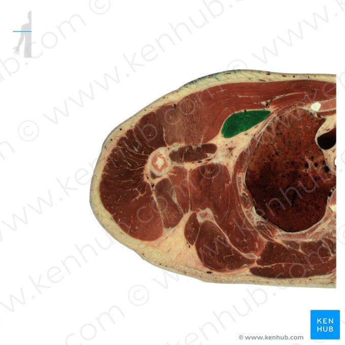 Pectoralis minor muscle (Musculus pectoralis minor); Image: National Library of Medicine