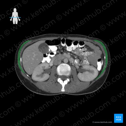 Musculus obliquus externus abdominis (Äußerer schräger Bauchmuskel); Bild: 