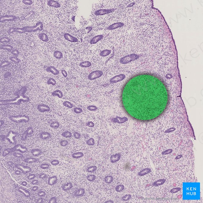 Stromal edema; Image: 