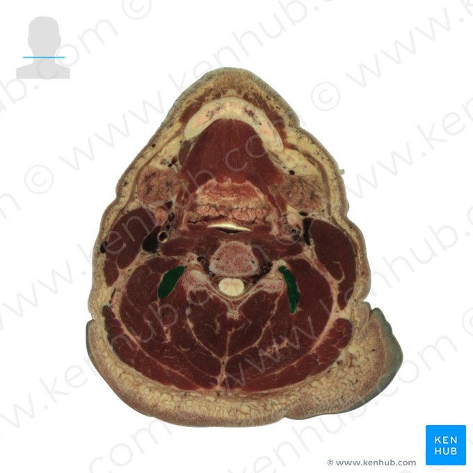 Musculus longissimus capitis (Kopfteil des langen Rückenmuskels); Bild: National Library of Medicine