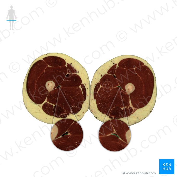 Deep femoral artery (Arteria profunda femoris); Image: National Library of Medicine