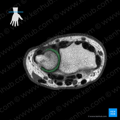 Discus articulationis radioulnaris distalis (Gelenkscheibe des distalen Radioulnargelenks); Bild: 