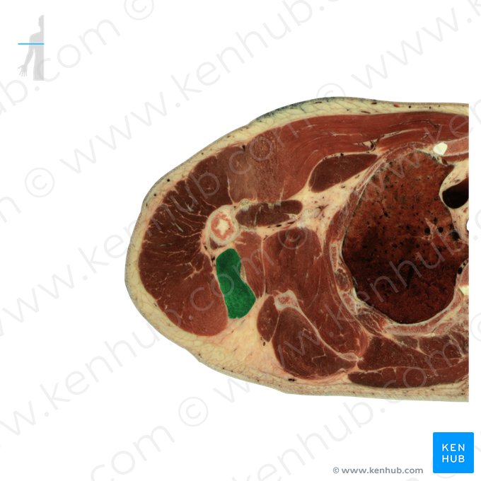 Cabeça longa do músculo tríceps braquial (Caput longum musculi tricipitis brachii); Imagem: National Library of Medicine