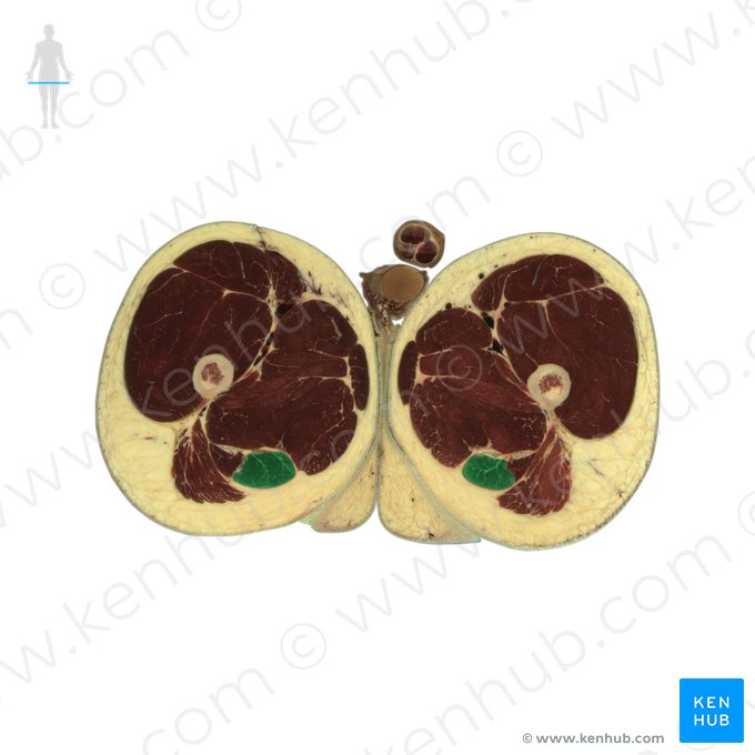 Musculus semitendinosus (Halbsehnenmuskel); Bild: National Library of Medicine