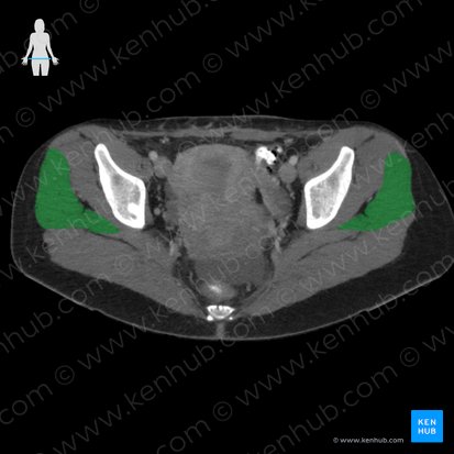 Músculo glúteo medio (Musculus gluteus medius); Imagen: 