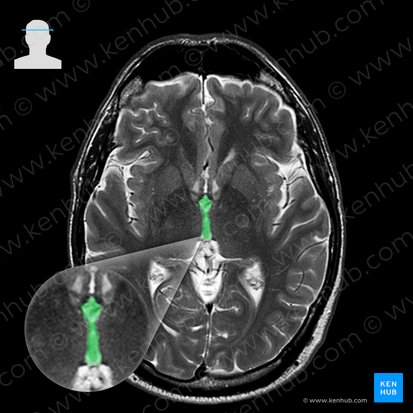 Third ventricle (Ventriculus tertius); Image: 