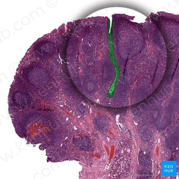 Surface invagination; Image: 