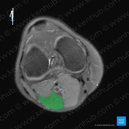 Lateral head of gastrocnemius muscle (Caput laterale musculi gastrocnemii); Image: 