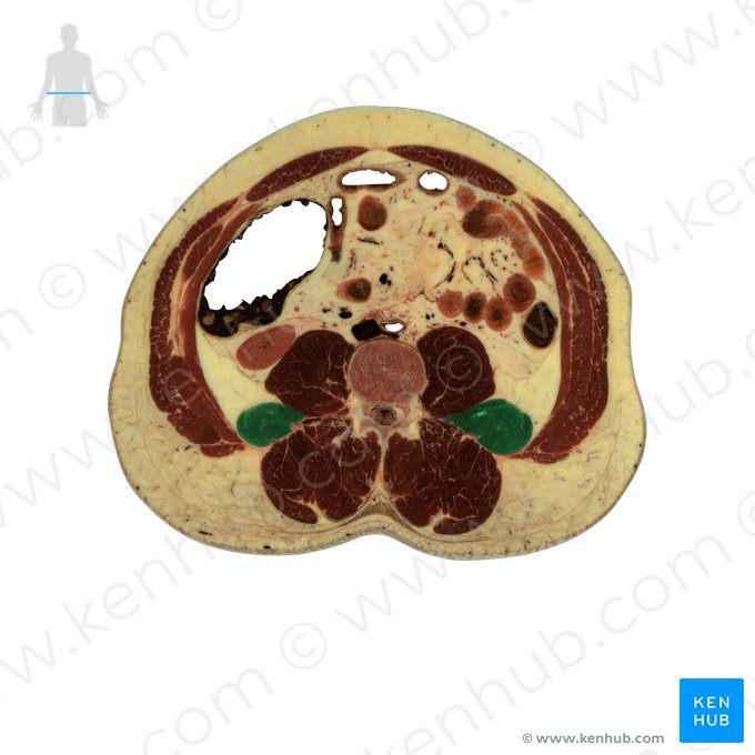 Musculus quadratus lumborum (Viereckiger Lendenmuskel); Bild: National Library of Medicine