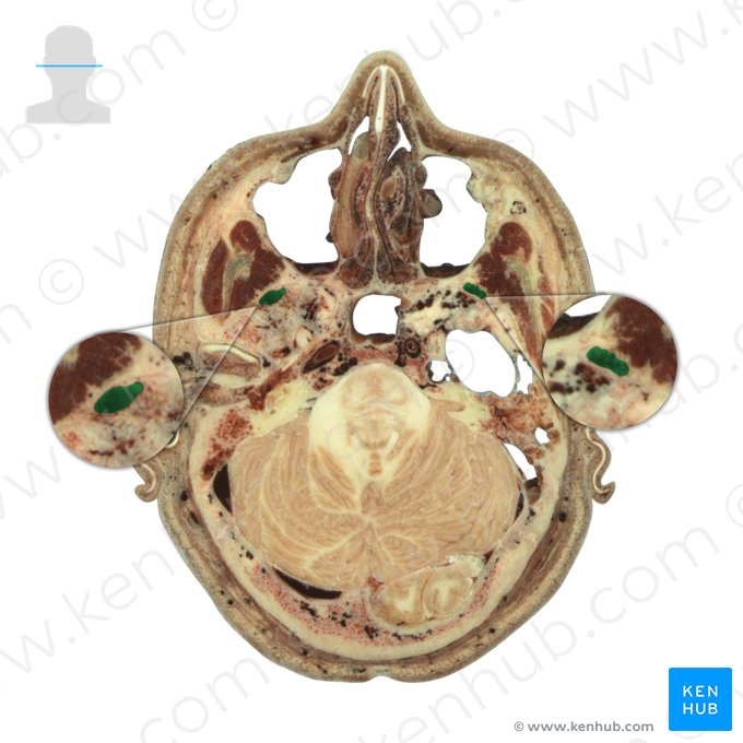 Músculo pterigóideo lateral (Musculus pterygoideus lateralis); Imagem: National Library of Medicine