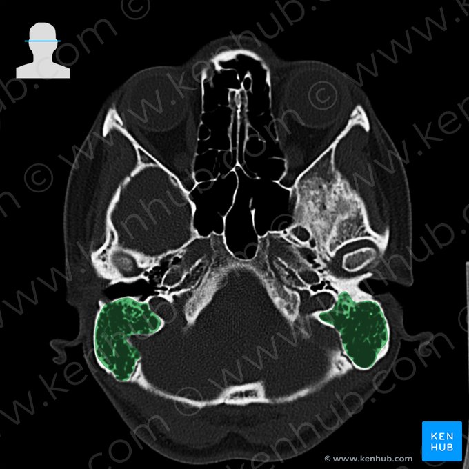 Células mastóideas (Cellulae mastoideae); Imagem: 