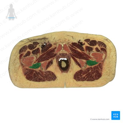 Músculo quadrado femoral (Musculus quadratus femoris); Imagem: National Library of Medicine