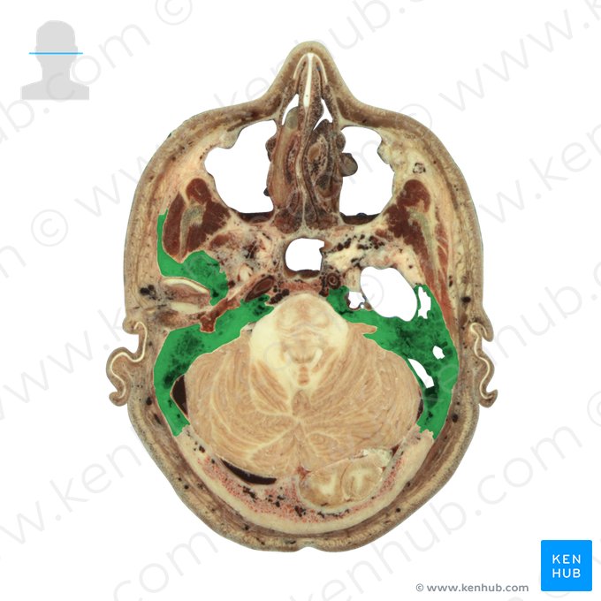 Osso temporal (Os temporale); Imagem: National Library of Medicine