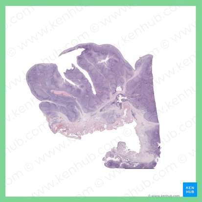 Palatine tonsil (Tonsilla palatina); Image: 