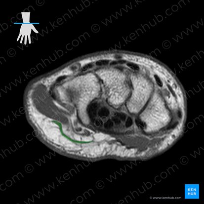 Musculus palmaris brevis (Kurzer Hohlhandmuskel); Bild: 