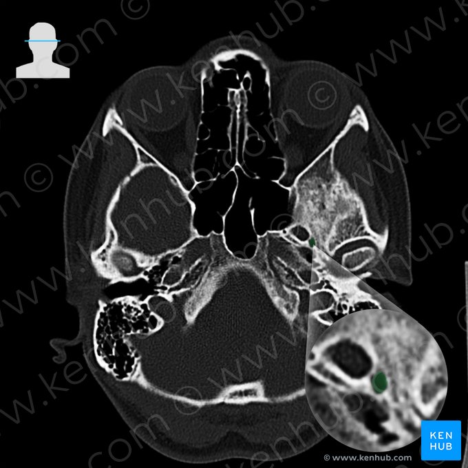 Foramen espinoso del hueso esfenoides (Foramen spinosum); Imagen: 