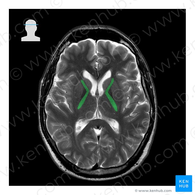 Internal capsule (Capsula interna); Image: 