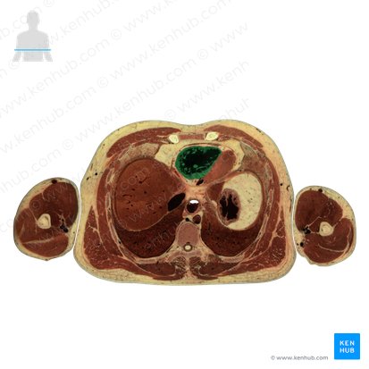 Ventrículo direito do coração (Ventriculus dexter cordis); Imagem: National Library of Medicine