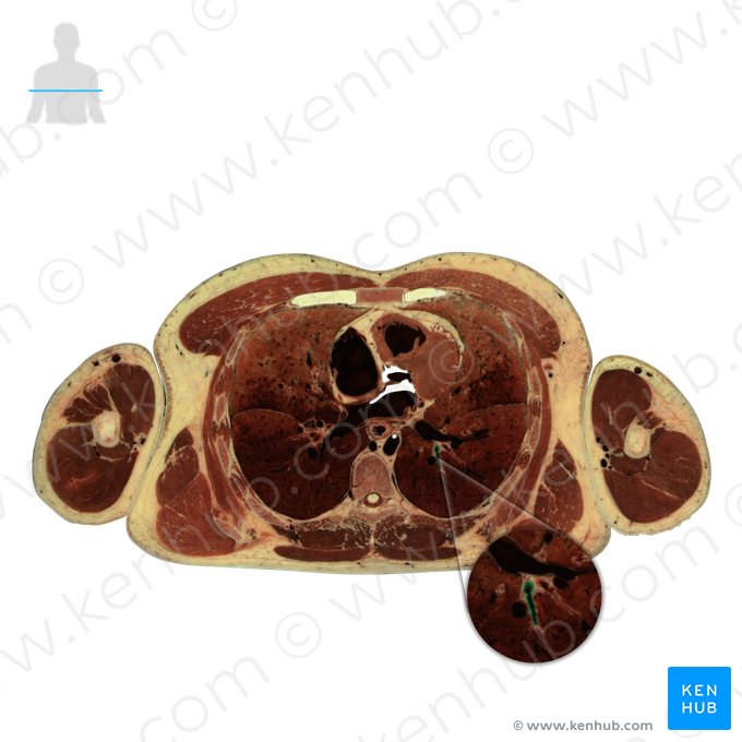 Brônquio lobar inferior esquerdo (Bronchus lobaris inferior sinister); Imagem: National Library of Medicine