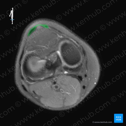 Ligamento patelar (Ligamentum patellae); Imagen: 