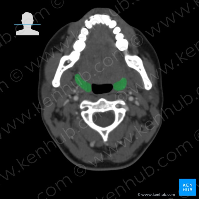 Palatine tonsil (Tonsilla palatina); Image: 