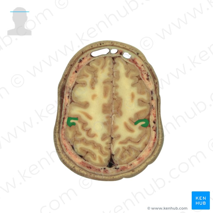 Gyrus postcentralis (Hintere Zentralwindung); Bild: National Library of Medicine