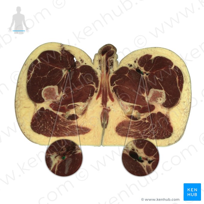 Deep femoral artery (Arteria profunda femoris); Image: National Library of Medicine