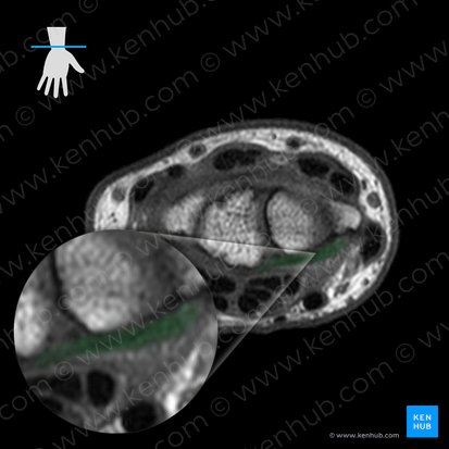 Palmar radiocarpal ligament (Ligamentum radiocarpeum palmare); Image: 