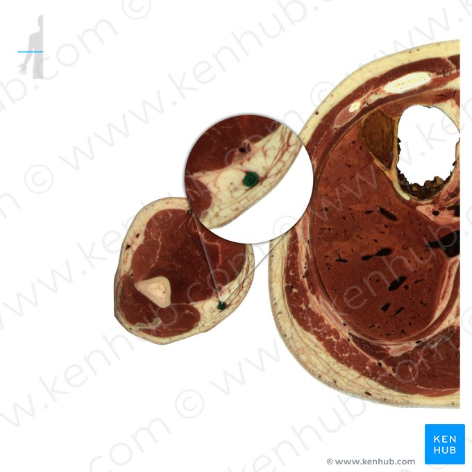 Basilic vein (Vena basilica); Image: National Library of Medicine