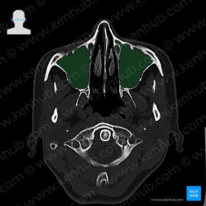 Sinus maxillaire (Sinus maxillaris); Image : 