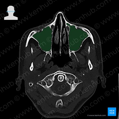 Seio maxilar (Sinus maxillaris); Imagem: 