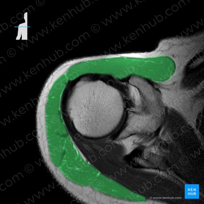 Deltoid muscle (Musculus deltoideus); Image: 