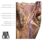 Clinical case: Iliac Vein Compression Syndrome