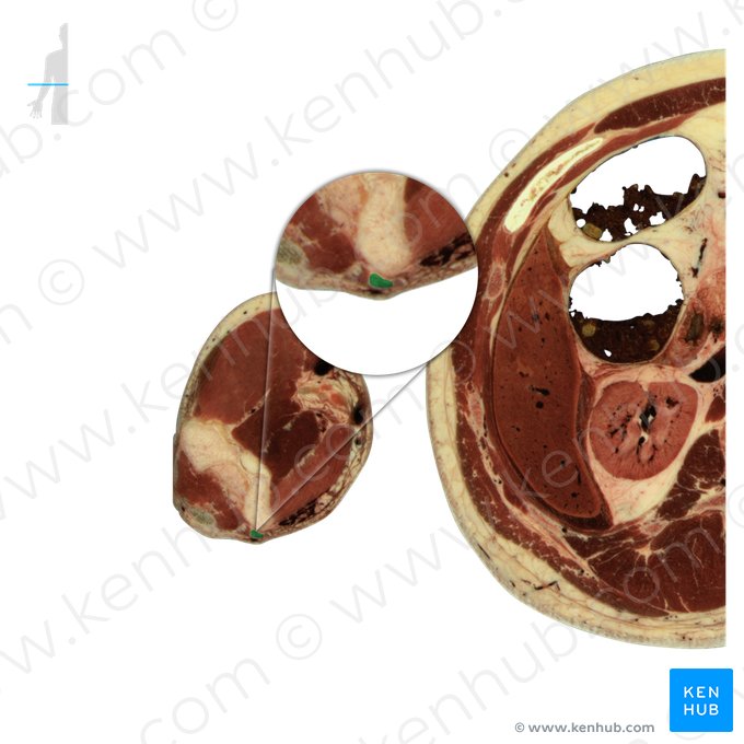 Ulnar nerve (Nervus ulnaris); Image: National Library of Medicine