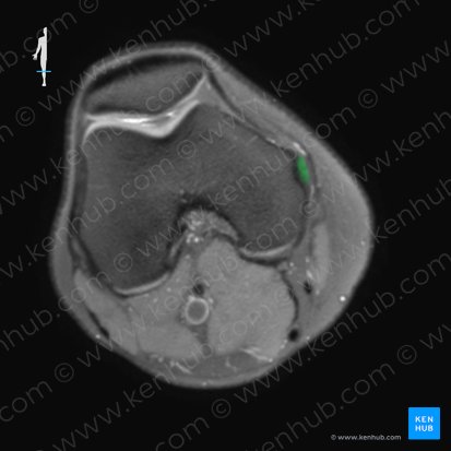 Ligamentum collaterale tibiale genus (Inneres Kollateralband des Kniegelenks); Bild: 