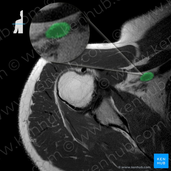 Arteria axillaris (Achselarterie); Bild: 