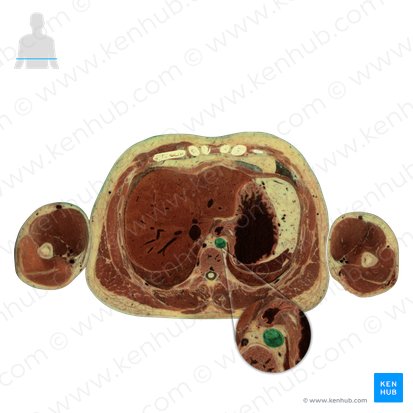 Aorta descendente torácica (Aorta thoracica descendens); Imagem: National Library of Medicine