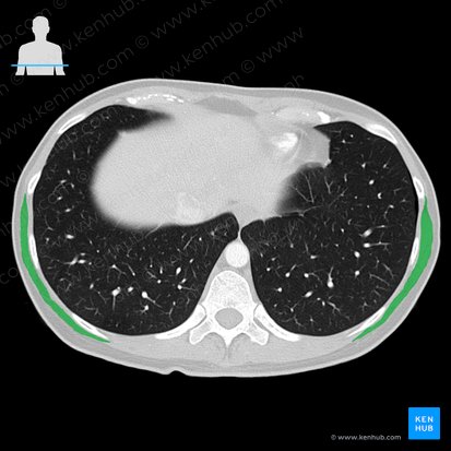 Músculo latíssimo do dorso (Musculus latissimus dorsi); Imagem: 