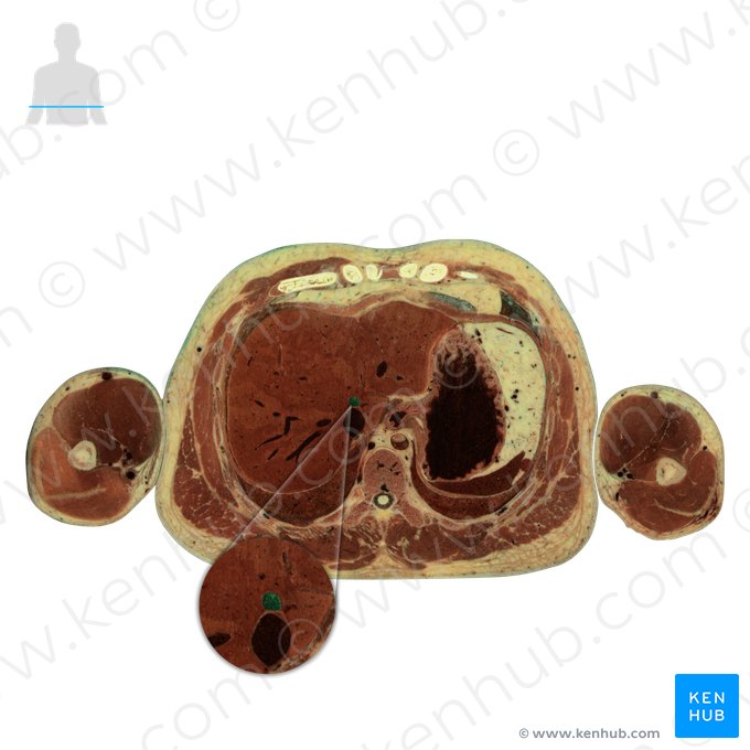 Venae hepaticae (Lebervenen); Bild: National Library of Medicine