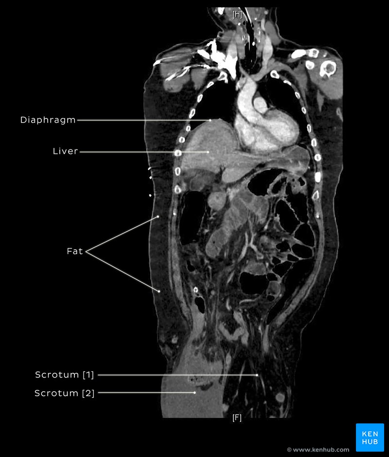 Giant inguinal hernia - Coronal CT at mid-axillary level