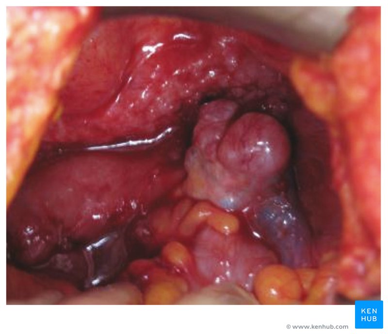 Ovarian tumor