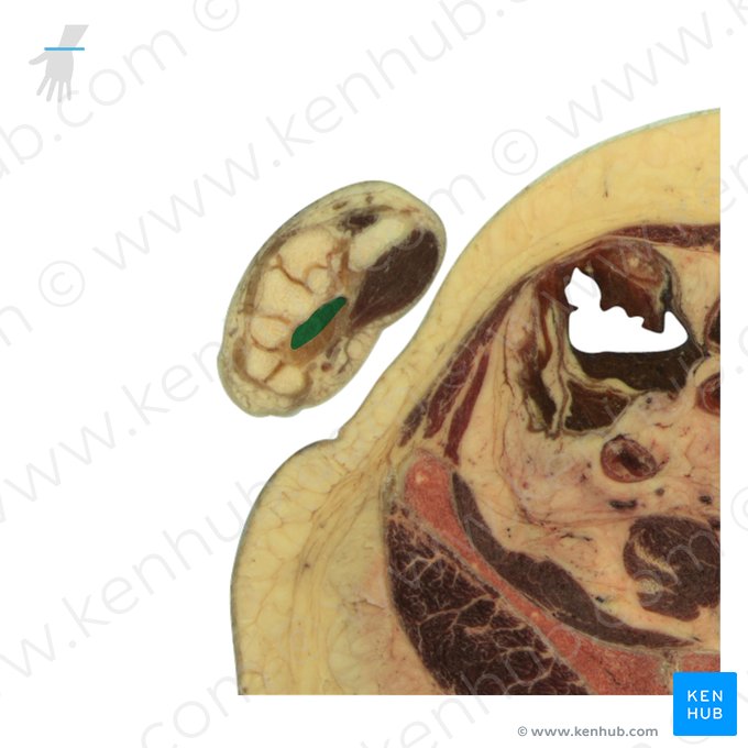 Tendão do músculo flexor profundo dos dedos (Tendines musculi flexoris digitorum profundus); Imagem: National Library of Medicine