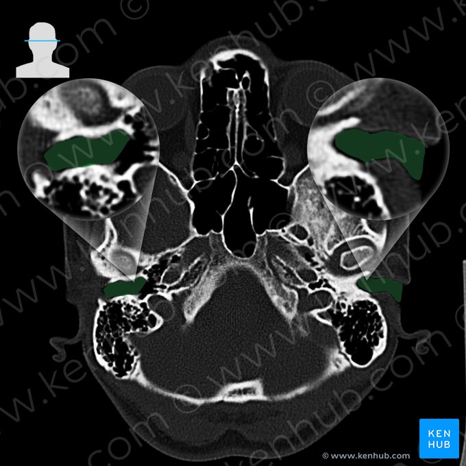 Conducto auditivo externo del hueso temporal (Meatus acusticus externus); Imagen: 