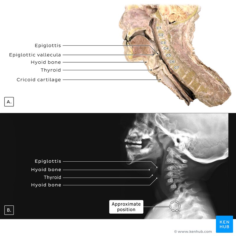 Lateral neck radiograph of a child