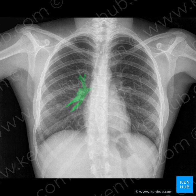 Ramas de la arteria pulmonar derecha (Rami arteriae pulmonalis dextrae); Imagen: 