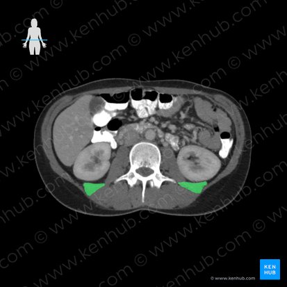 Músculo quadrado lombar (Musculus quadratus lumborum); Imagem: 