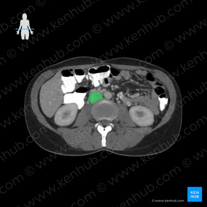 Inferior vena cava (Vena cava inferior); Image: 