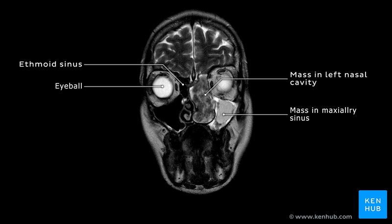 Tumour in the nasal cavity and maxillary sinus - coronal T2 MRI